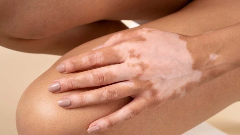vitiligo tedavisi