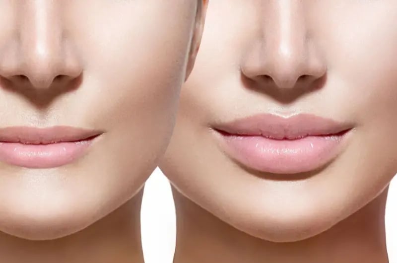 Dudak Dolgusu Kalıcılığı Ne Kadar Sürer? Erime Süresi ve İpuçları
