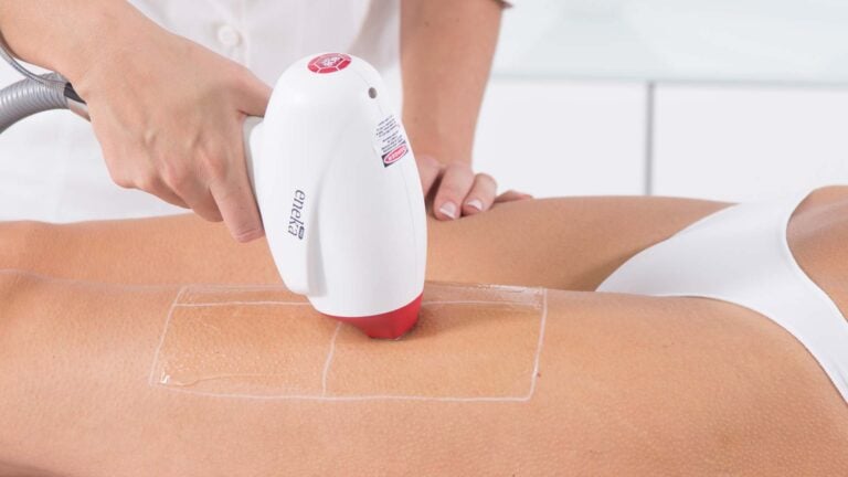 lazer epilasyon atış derecesi