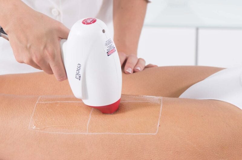 Lazer Epilasyon Atış Derecesi Kaç Olmalı?