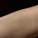 Lazer Sonrası Kaşıntı