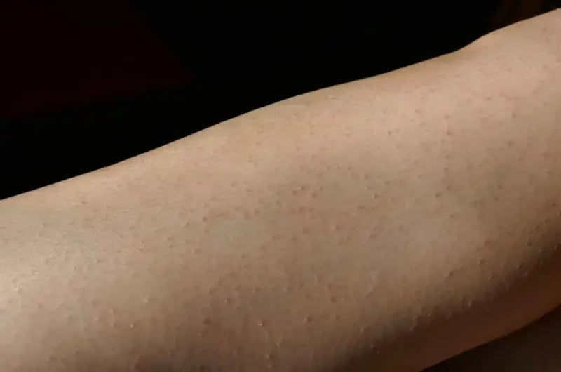 Lazer Sonrası Kaşıntı: Nedenleri, Çözümleri ve Önleme Yolları