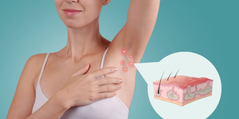 Hidradenitis Suppurativa Hastalığı Tedavisi