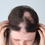 Alopesi Areata