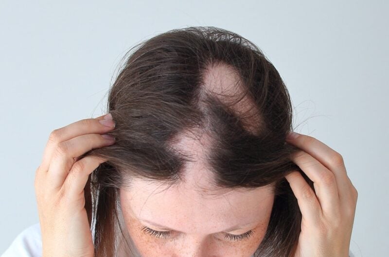 Alopesi Areata (Saç Kıran): Nedenleri, Belirtileri ve Tedavi Yöntemleri