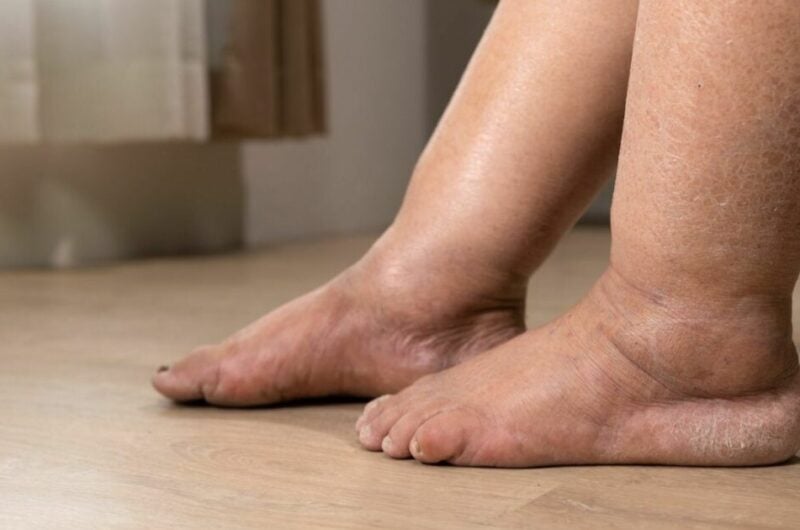 Bacaklarda Ödem Nasıl Atılır? Etkili Yöntemler ve Doğal Çözümler