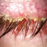 demodex nedir