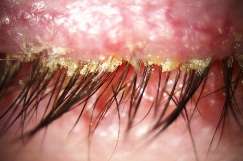 Demodex Nedir? Belirtileri, Tedavisi ve Korunma Yöntemleri