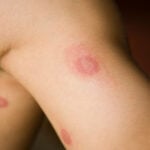 dermatofit nedir