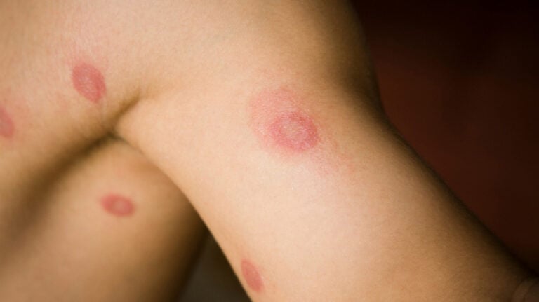 dermatofit nedir