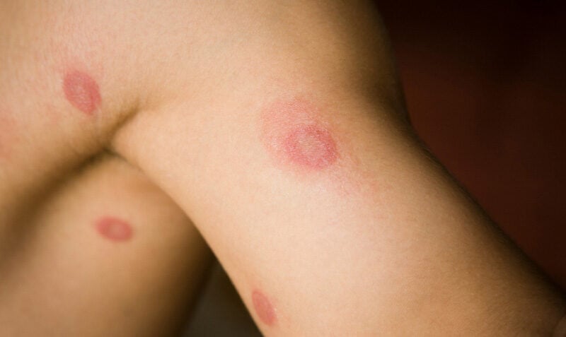 Dermatofit Nedir? Mantar Enfeksiyonlarının Nedenleri ve Tedavi Yöntemleri