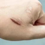 keloid tedavisi