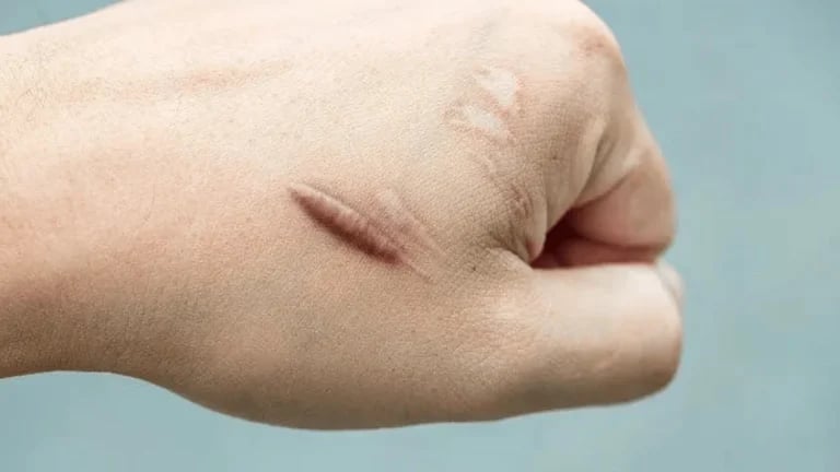 keloid tedavisi