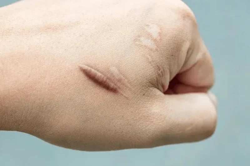 Keloid Tedavisi: Güncel Tedavi Yöntemleri ve Etkili Çözüm Önerileri