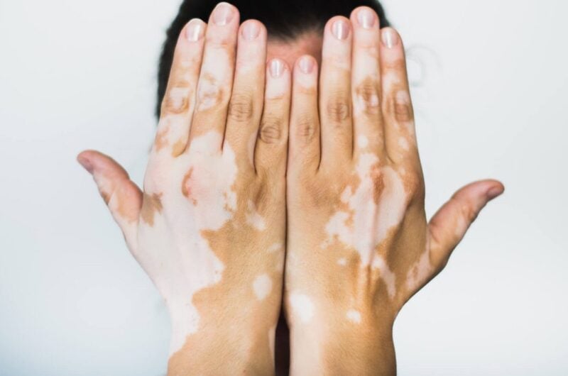 Melanosit Nedir? Pigment Üreten Hücrelerin Detaylı İncelemesi
