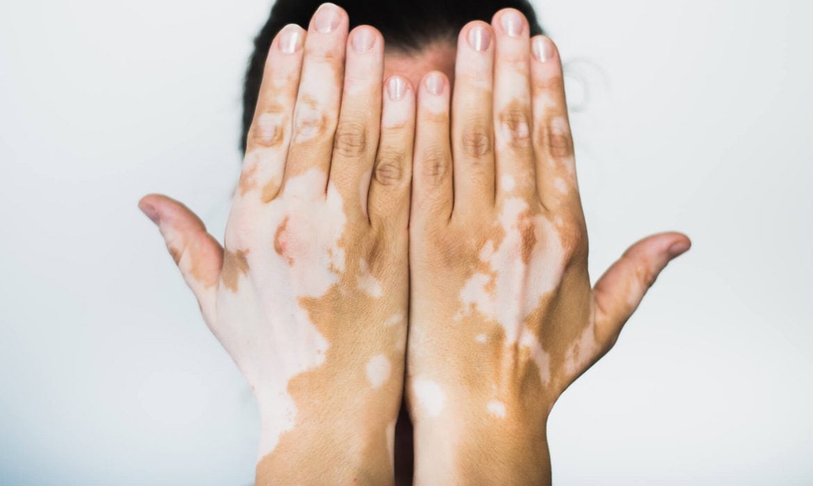 Melanosit Nedir? Pigment Üreten Hücrelerin Detaylı İncelemesi
