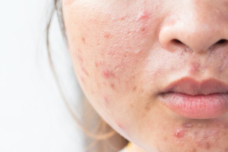 roaccutane