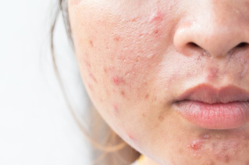 Roaccutane Tedavisi: Kullanım Rehberi ve Dikkat Edilmesi Gerekenler