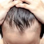 telogen effluvium nedir