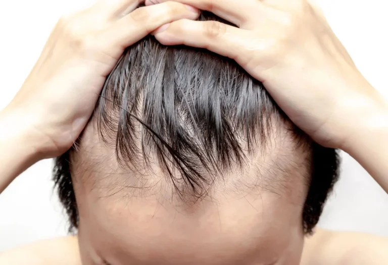 telogen effluvium nedir