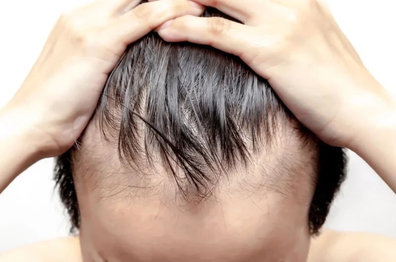 Telogen Effluvium Nedir? Belirtileri ve Tedavi Yöntemleri