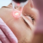 yüze lazer yapılır mı