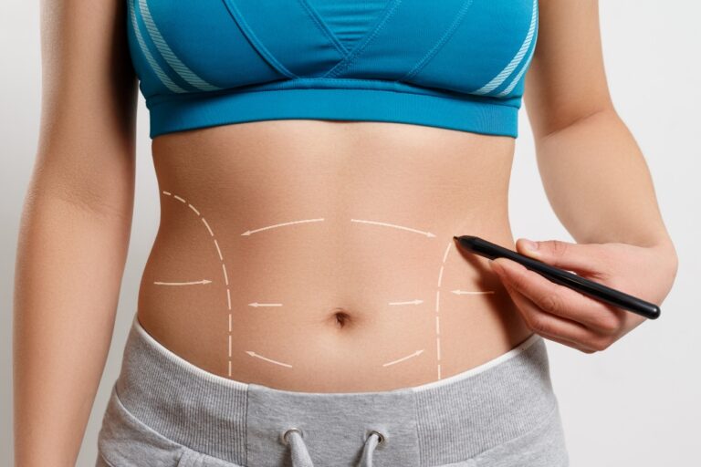 ankara Abdominoplasti