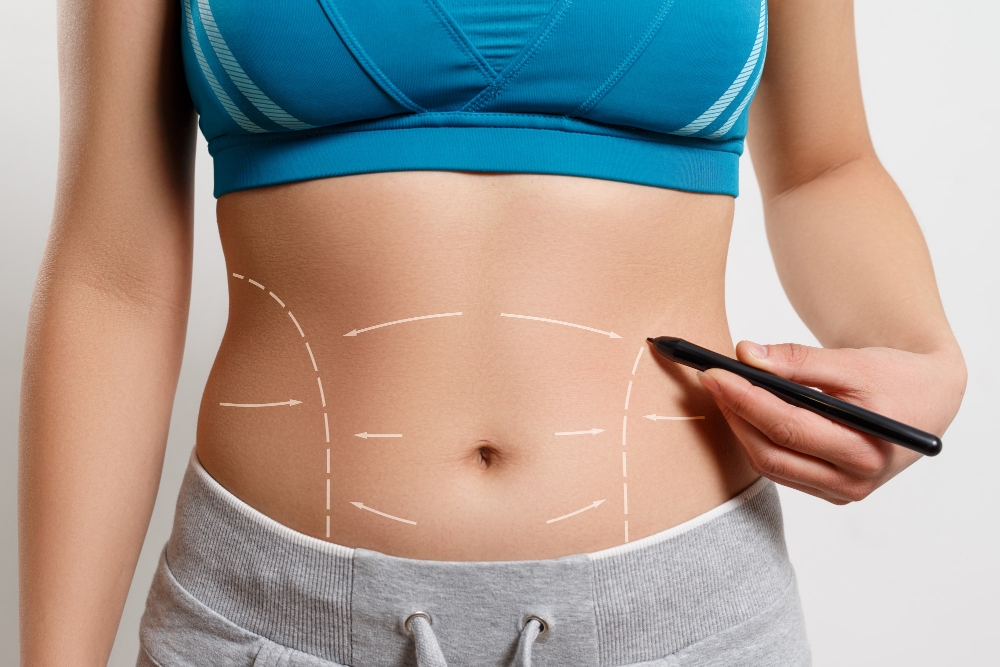 ankara Abdominoplasti