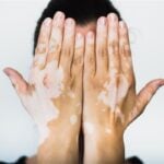 vitiligo olmayan beyaz lekeler
