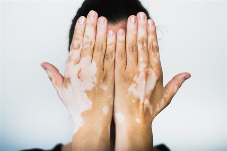 vitiligo olmayan beyaz lekeler