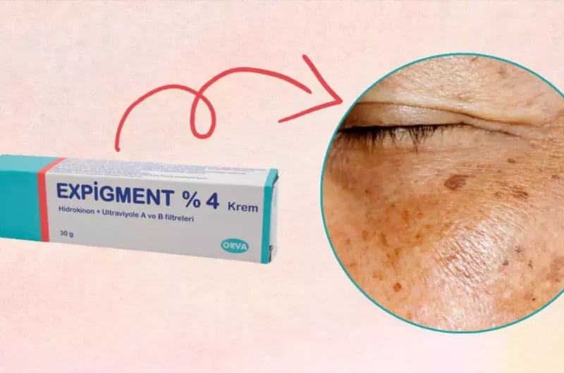 Expigment Krem Nasıl Kullanılır? Formüller ve Yan Etkileri
