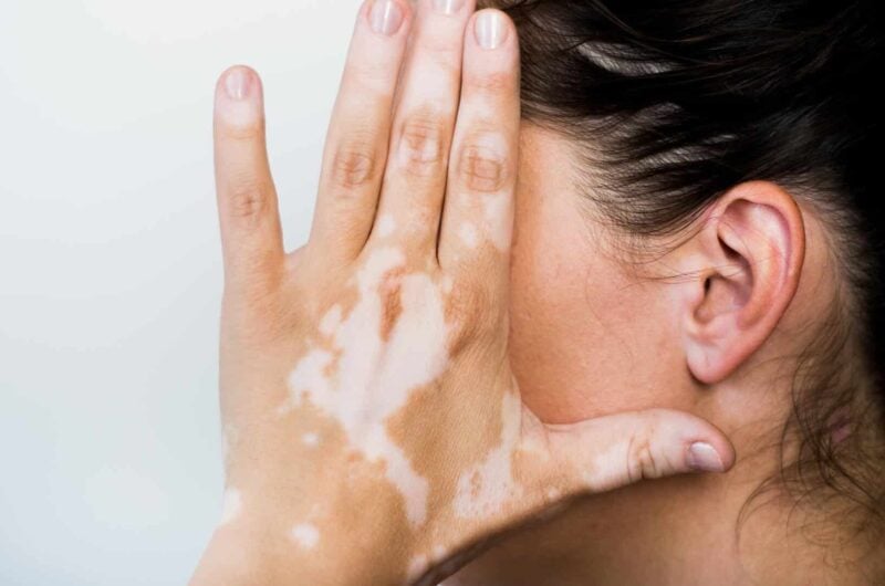 Vitiligo Beslenme Önerileri: Doğal Tedavi ve Vitamin Desteği