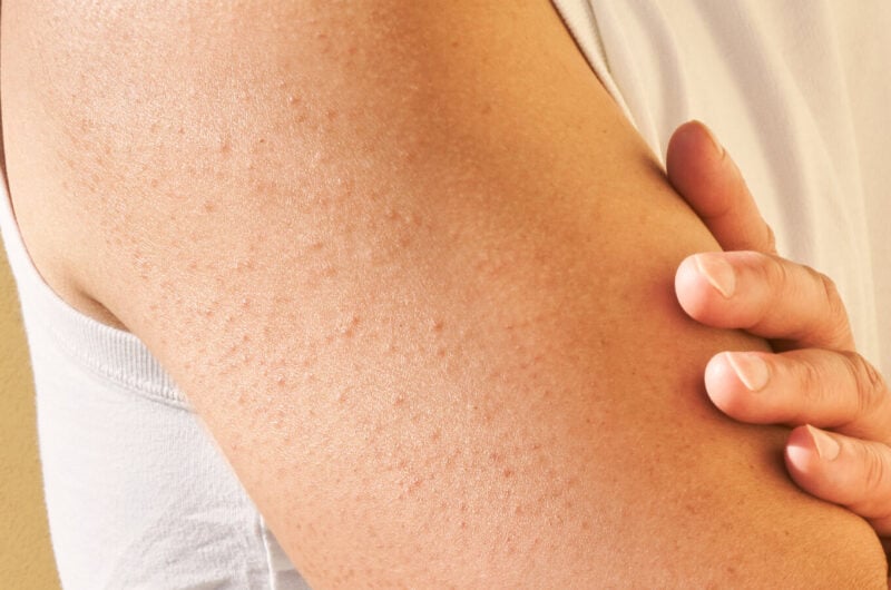 Keratosis Pilaris: Nedenleri, Belirtileri ve Tedavi Yolları
