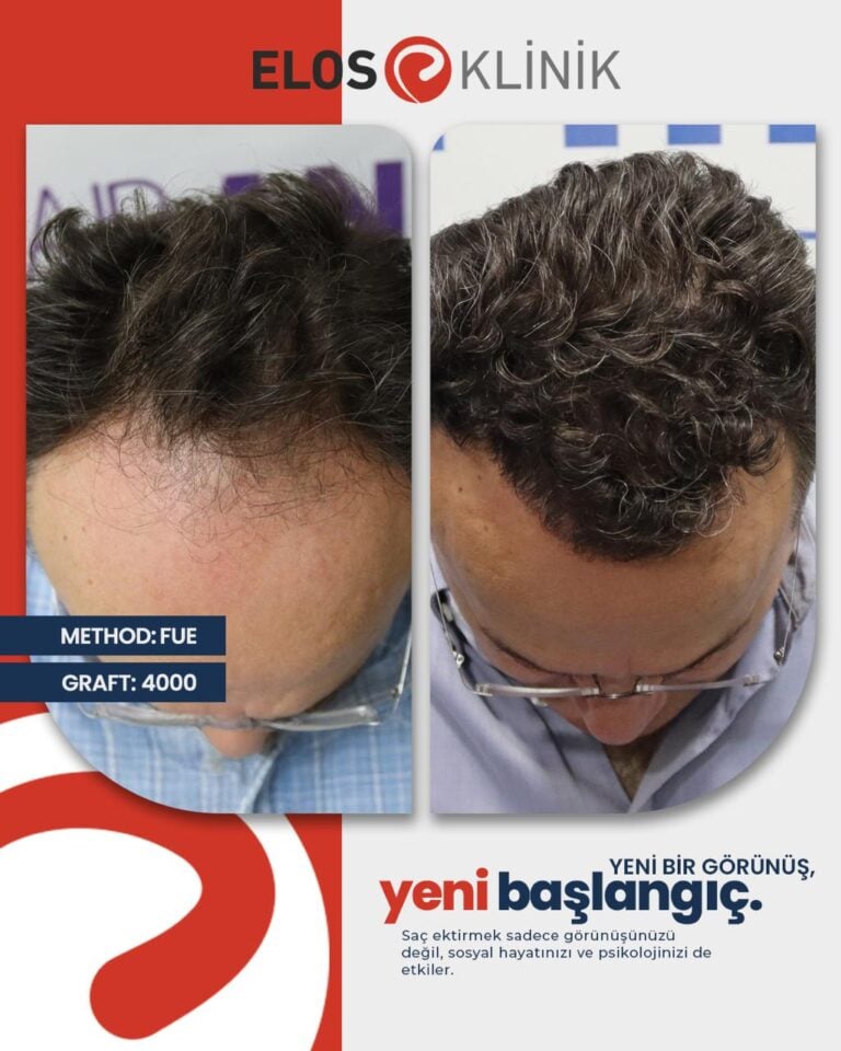 Sa&ccedil; Ekimi Sonu&ccedil;ları