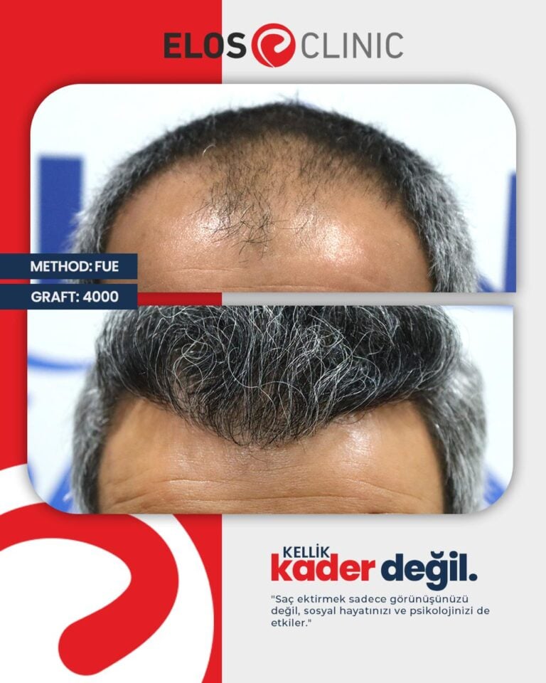 Sa&ccedil; Ekimi Before After